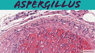 Aspergillus Cutaneous Aspergillosis  Angioinvasive Fungus 5Minute Pathology Pearls [upl. by Scot459]