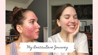 Roaccutane  My 6 Month Journey to Clear Skin [upl. by Anialad781]