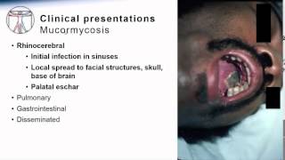 Mucormycosis [upl. by Andaira]