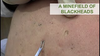 A Minefield of Blackheads  Dr Derm [upl. by Sheeran977]