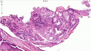 Barrett Esophagus  Histopathology [upl. by Esilram]