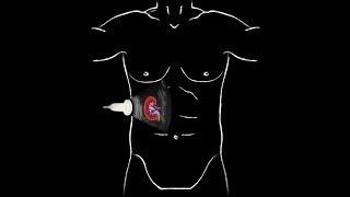 POCUS  Basic Renal Ultrasound [upl. by Thilde]