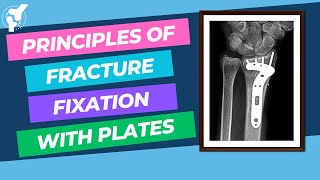 Principles of Fracture Internal Fixation With Plates and Screws  Material Properties [upl. by Weisburgh]