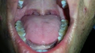 Tongue Fasciculation in MND [upl. by Devad]