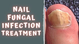 HOW TO TREAT FUNGAL NAIL INFECTION  TINEA UNGUIUM  ONYCHOMYCOSIS [upl. by Cathleen225]