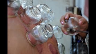 Cupping Pain Therapy [upl. by Yrrad]