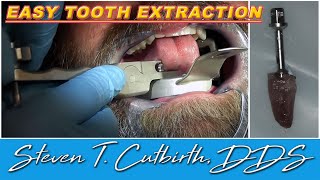 Easy Tooth Extraction  Dental Minute with Steven T Cutbirth DDS [upl. by Eveivenej]