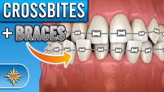 How Do BRACES Fix Crossbites [upl. by Aimat]