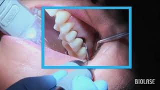 Remoción de caries con lasers Biolase  Streamhealth Dental [upl. by Reynold]