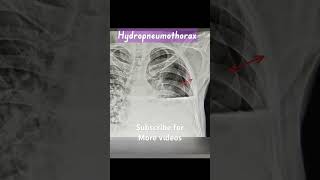 Hydropneumothorax [upl. by Diver]