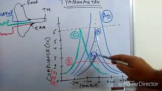 Tympanometry Impedance Audiometry [upl. by Fred]