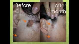 Natural treatment for seborrheic keratosis before and after photos [upl. by Granny734]