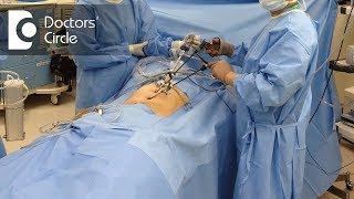 My Laparoscopic Myomectomy Fibroid Surgery Advice [upl. by Nonnaihr]