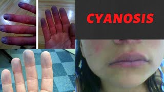 CYANOSIS  Causes Symptoms Types Treatment I What is cyanosis Peripheral and Central Cyanosis [upl. by Aliuqet]