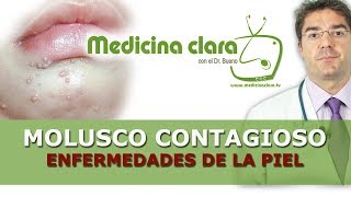 Enfermedades piel Molusco contagioso pápulas perladas granos en niños [upl. by Llenoil]