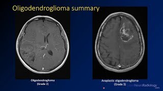 Imaging brain tumors  3  Oligodendrogliomas [upl. by Aixela]