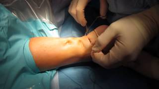 Percutaneous Achilles Tendon Surgery Repair Unedited by Kevin R Stone MD [upl. by Akcebar]