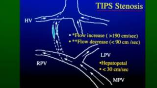 Doppler Evaluation of TIPS Shunts [upl. by Yrrep]