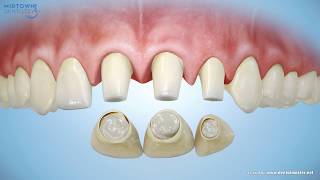 Are Porcelain Veneers Right for You [upl. by Rowland362]