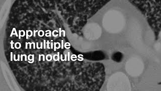 Algorithmic Approach to Multiple Lung Nodules [upl. by Elliven]