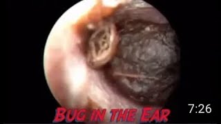 Insect inside the ear [upl. by Nema]