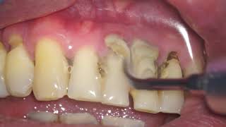 HEAVY CALCULUS TARTAR REMOVAL ULTRASONIC TIP DENTAL HYGIENE [upl. by Anilad325]