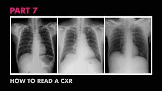 Cardiac Silhouette  How to Read a Chest XRay Part 7  MEDZCOOL [upl. by Savadove706]