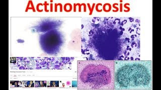 Actinomycosis Medschooltutorial [upl. by Fairfax]