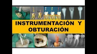 quotINSTRUMENTACION Y OBTURACIÓNquot por el Dr Nestor Jaime [upl. by Nylzaj338]