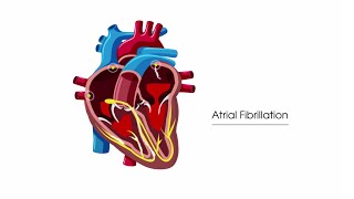 What is atrial fibrillation [upl. by Einnim]