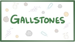 Gallstones cholelithiasis [upl. by Nicolle]