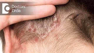 Treatment options for Scalp Psoriasis  Dr Rashmi Ravindra [upl. by Nylleoj]