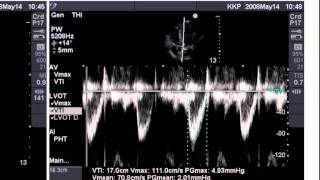 Point of Care Echo Stroke Volume Determination [upl. by Yruok]