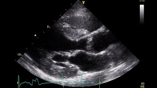 PVC Echo Parasternal Long Axis View  Aortic Stenosis [upl. by Eittak]