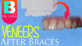 Dental Veneers after Braces or Invisalign [upl. by Petty440]