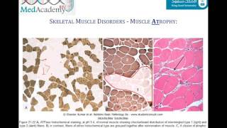 Scleroderma Associated Myopathy Treatment  Johns Hopkins [upl. by Eiuqnimod]