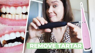 HOW TO REMOVE CALCULUS TARTAR PLAQUE AT HOME  Ultrasonic Tooth Cleaner Review  Does It Work [upl. by Jeremiah]