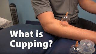 What is Cupping [upl. by Atilrac304]