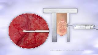 Brevera Breast Biopsy System  Animation [upl. by Oulman]