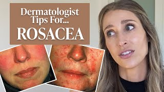 Dermatologist’s Guide to Rosacea What Is It Dos amp Don’ts Treatment Tips amp More  Dr Sam Ellis [upl. by Frederich]