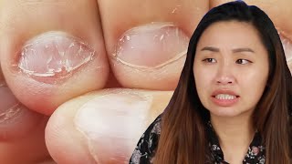 Nail Biters Learn Horrifying Facts About Biting Your Nails [upl. by Yerfoeg12]