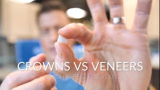 CROWNS VS VENEERS  Which is best [upl. by Janeczka]