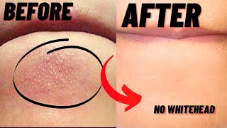 How To Remove Whiteheads And Blackheads From Chin At Home [upl. by Zetnom]