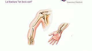 Les différents types de fractures [upl. by Sydelle]