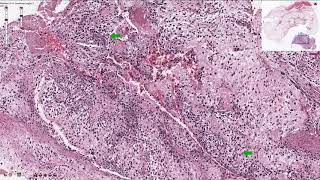 Osteosarcoma  Histopathology [upl. by Kihtrak695]