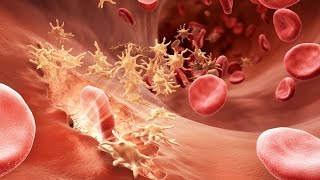 Understanding Hemophilia [upl. by Ispep]