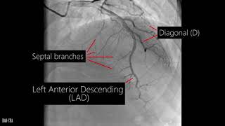 Pulmonary Angiography Procedure Angiogram Balloon Video [upl. by Yeclehc]