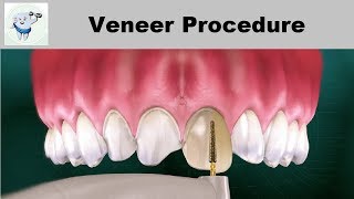 Dental Veneers Procedure Step by step [upl. by Dlonyer241]