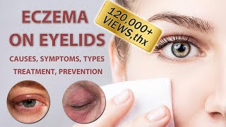 Eczema on Eyelids 2022  2023  Causes Symptoms Types Treatment and Prevention [upl. by Attenra300]