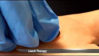 Hospital Uses Leeches to Heal Patients [upl. by Anahsor]